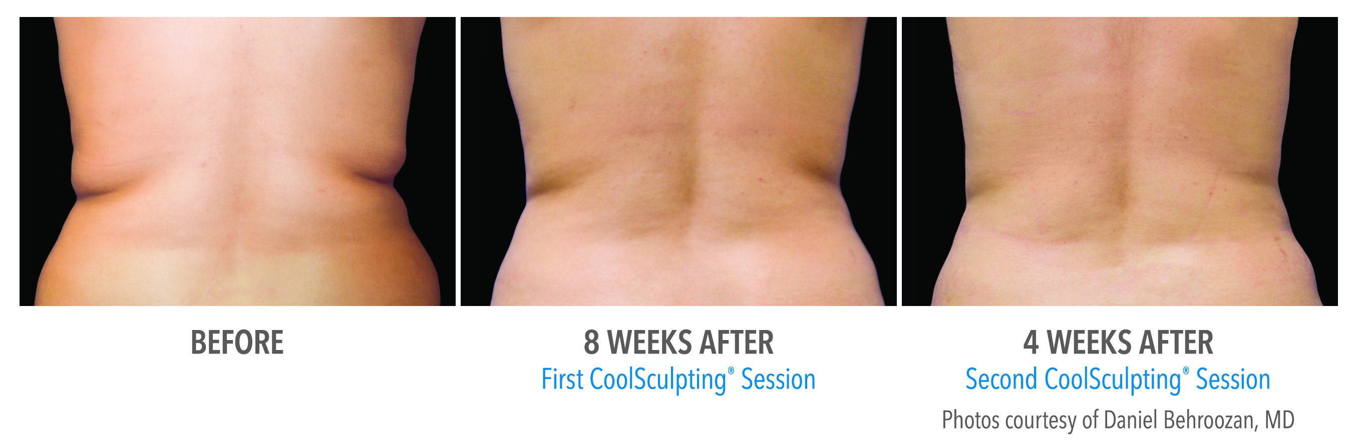 CoolSculpting Fat Freezing Flanks